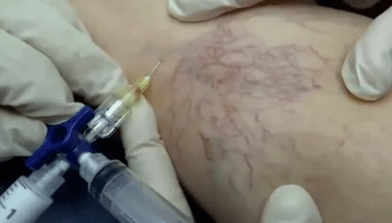 skleroterapija krčnih žil