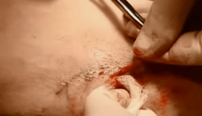 vrste operacij za odstranjevanje krčnih žil